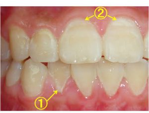 なんで歯石はつくの ハート歯科クリニック いまい