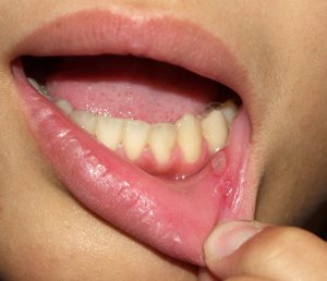 口 口内炎 手足 病 アフタ性口内炎と手足口病の関係性は？