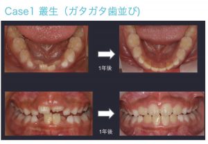 小児のマウスピース矯正(マイオブレース矯正)の費用と特徴 | ハート