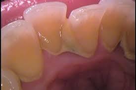 歯石のお掃除って 意味があるの 痛くはないの ハート歯科クリニック いまい