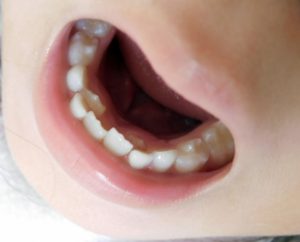 抜き 方 乳歯 【グラグラ乳歯 乳歯の痛くない抜き方】自宅での乳歯の抜歯について解説