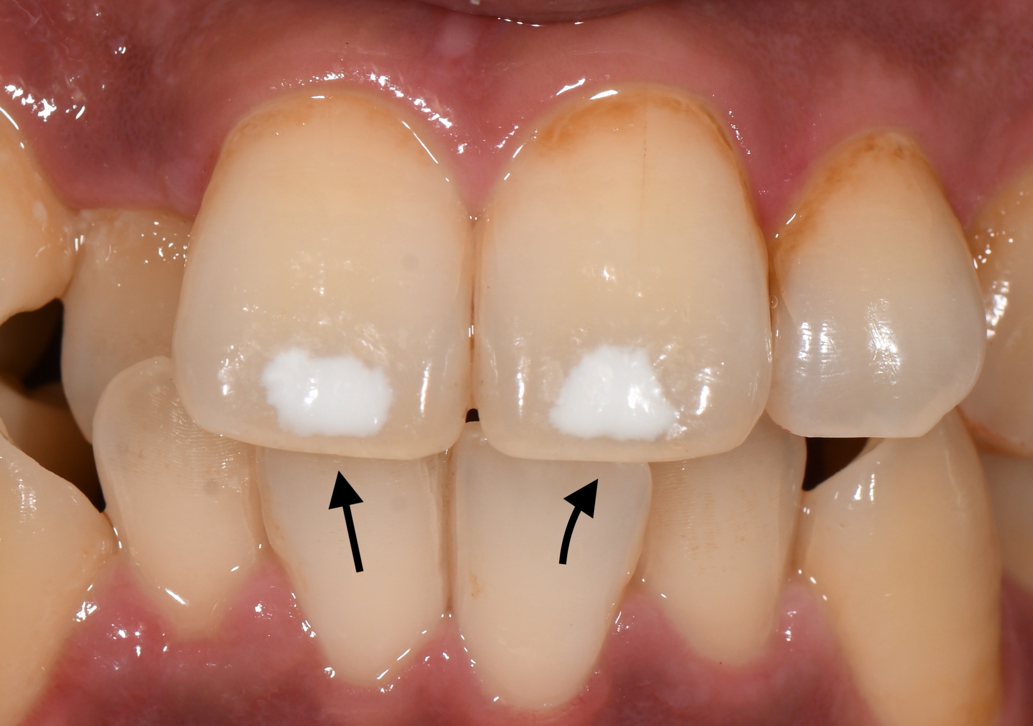 歯の一部が白いのは虫歯ですか ハート歯科クリニック いまい